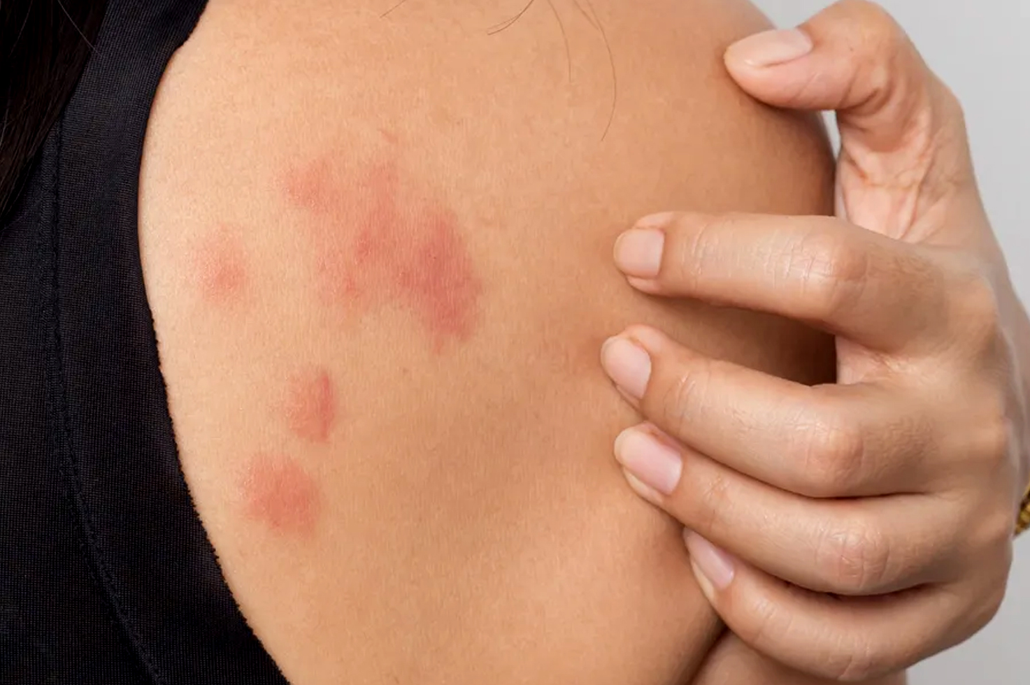 What are the of causes hives? | What are the symptoms of hives? | How long do hives last? | When to seek medical treatment for hives? | How are the hives treated and cured? | Various pictures of hives | diseases that cause hives in adults male and female | what are the Causes of hives in female adults | Can hives be a sign of something serious diseases |Various treatment of hives | How to cure hives fast and quick | Pictures of hives rash on legs and hand